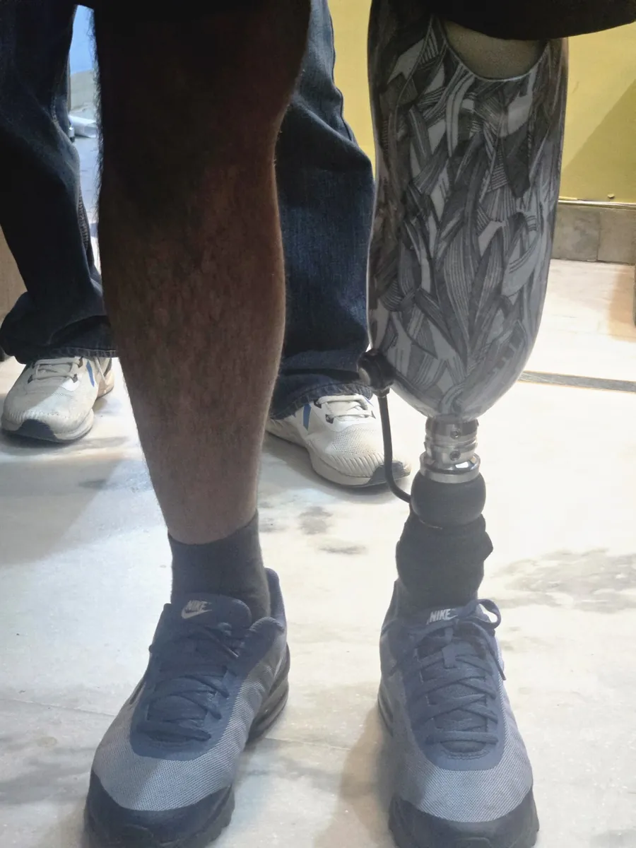 Below-knee prosthesis standing view