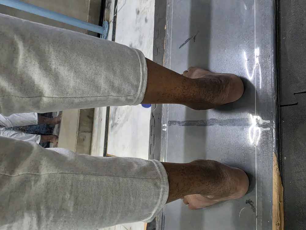 Footscan pressure plate assessment