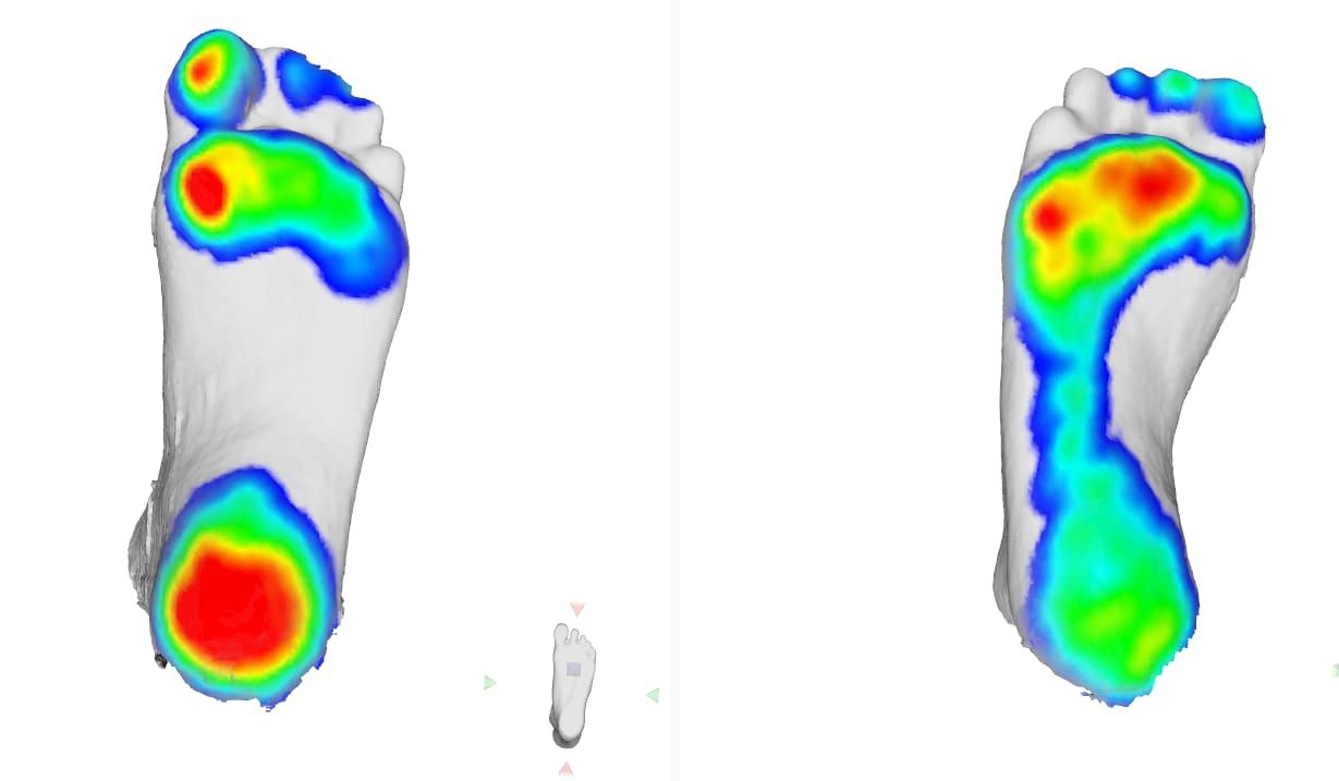 PHITS 3D printed insole pressure design